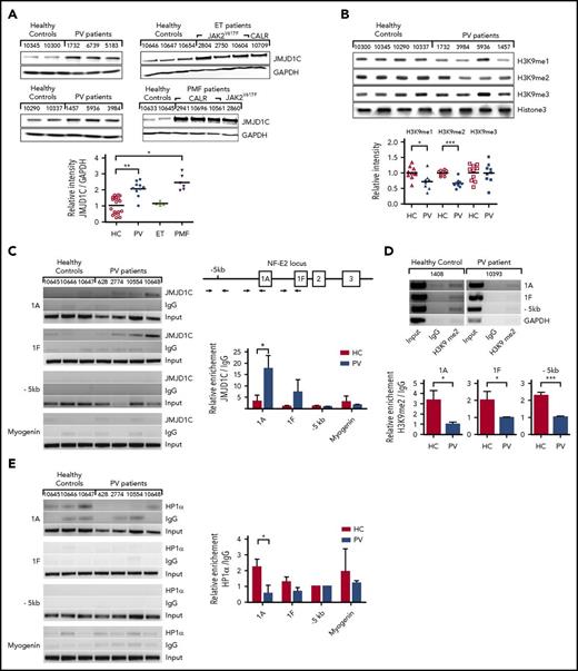 Figure 3. Regulation of NFE2 expression by JMJD1C via a positive feedback loop entailing H3K9 demethylation. (A) JMJD1C expression in PV, ET, and PMF patients and healthy controls (HC). Peripheral blood granulocytes from n = 10 PV patients, n = 4 ET patients (3 JAK2V617F, 1 CALR-mutated), n = 6 PMF (2 JAK2V617F, 4 CALR-mutated) patients, and n = 19 healthy controls were analyzed by western blotting and densitometry (below). Representative blots are shown. Patient characteristics are given in supplemental Table 6. The Kruskal-Wallis showed that groups did not originate from the same distribution (P < .0001). Groups were therefore compared by using the Wilcoxon signed-rank test. *P < .05; **P < .001. (B) Global H3K9me3, H3K9me2, H3K9me1 levels in PV patients and healthy controls. Peripheral blood granulocytes from n = 10 PV patients and n = 9 healthy controls were analyzed by western blotting. One representative blot of 3 and the densitometric analysis of n = 10 and n = 9, respectively, are shown. ***P < .001; *P < .05. (C) JMJD1C binding in the NFE2 locus in PV patients and healthy controls. Peripheral blood granulocytes of n = 4 PV patients and n = 3 healthy controls were chromatin immunoprecipitated with an antibody against JMJD1C or an IgG control. Top: chromatin immunoprecipitated DNA was amplified with primers covering the -1A and -1F promoter as well as the −5-kb region in the NFE2 locus, illustrated in the schematic representation. Bottom: densitometric analysis of ChIP results. Graphs represent mean ± SEM. *P < .05 by the Student t test. (D) H3K9me2 levels in the NFE2 locus in PV patients and healthy controls. Peripheral blood granulocytes of n = 6 PV patients and n = 7 healthy controls were chromatin immunoprecipitated with an antibody against H3K9me2 or an IgG control. Chromatin immunoprecipitated DNA was amplified as in panel C. One representative PV patient and healthy control each are depicted. Bottom: densitometric analysis. Graphs represent mean ± SEM. ***P < .001; *P < .05 by the Student t test. (E) HP1α binding in the NFE2 locus in PV patients and healthy controls. Peripheral blood granulocytes of n = 4 PV patients and n = 3 healthy controls were chromatin immunoprecipitated with an antibody against HP1α or an IgG control. Chromatin immunoprecipitated DNA was amplified as in panel C. Right, Densitometric analysis. Graphs represent mean ± SEM. *P < .05 by the Student t test. GAPDH, glyceraldehyde-3-phosphate dehydrogenase.