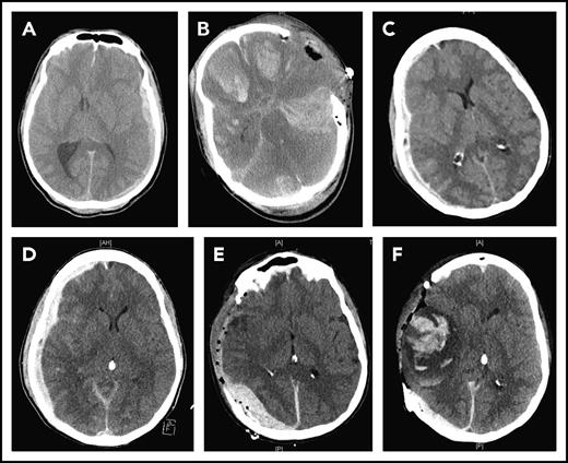 Figure 1. CT images of 2 TBI patients. The first patient suffered from subdural hematoma after a step fall (A) and developed diffused cerebral bleeding immediately after decompressive craniectomy (B). The second patient suffered from progressive subdural hematoma after a car accident (C-D) and developed delayed subdural and intracerebral hematomas after decompressive cranioctomy (E-F).
