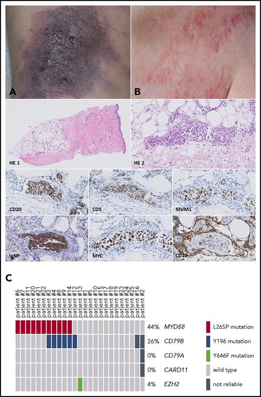 Figure 1. IVLBCL: skin lesions, histology, mutational status, and survival analysis. Skin lesions may present as bluish indurated plaques (A) or generalized telangiectasias (B). Histology of a representative skin biopsy shows a dermal blood vessel with intraluminal clustering of large, blastic cells (HE 1, HE 2), positive for CD20 (clone L26 from Dako, diluted 1:800), CD5 (clone 4C7 from Dako, diluted 1:400), MUM1 (clone MUM1p from Dako, diluted 1:100), IgM (polyclonal, from Dako, diluted 1:500), MYC (clone Y69 from ABCAM, diluted 1:100), and CD10 (clone 56C6 from Dako, diluted 1:20). Original magnification: ×50 for HE 1 and ×400 for HE 2, CD20, CD5, MUM1, IgM, MYC, and CD10. (C) OncoPrinter plot of the targeted next-generation sequencing data shows an MYD88 L265P mutation (NM_001172567) in 44%, a CD79B Y196 mutation (NM_001039933) in 26%, and an EZH2 Y646F mutation (NM_004456) in 4% of the patients. Patient numbers correspond to those in supplemental Table 1. In patients 16 and 2, the sequencing data of CD79B resp. CD79B/A and CARD11 were not reliable because of low read count (<100 reads).