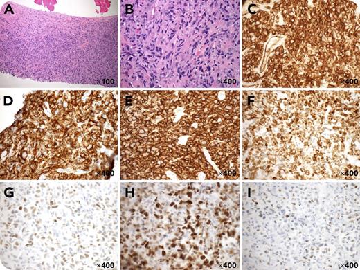 A 49-year-old man presented with an 8.8 × 6.5 cm, left infraclavicular subpectoral mass. A biopsy showed predominantly spindle-ish cells (panels A-B, hematoxylin and eosin stain; original magnifications shown on pictures) and was therefore worked up for soft tissue tumors initially. The spindle-ish cells were strongly positive for CD31 with membranous and cytoplasmic staining (panel C) but were negative for CD34, AE1/AE3, smooth muscle actin, desmin, and S100 (not shown). Further workup revealed positive stains for CD45 (panel D), CD20 (panel E), Bcl-2 (panel F), Mum-1 (panel G), and C-myc (panel H); partially positive stains for Bcl-6 (panel I); weakly positive stains for Pax-5 (not shown); and high Ki-67 proliferation index (90%, not shown). The cells were negative for CD3, CD10, LMP1, P53, CD5, and Bcl-1 (not shown). The overall findings are most consistent with a diffuse large B-cell lymphoma (DLBCL), activated B-cell subtype, with spindle-ish cell morphology and strong aberrant expression of CD31. / A few previous reports indicated that CD31 was detected in small cell lymphomas (by flow cytometry), plasmablastic lymphoma (weak stain), and cutaneous spindle cell B-cell lymphoma (focal weak stain). We believe this is the first documented case of DLBCL with strong diffuse expression of CD31. The spindle-ish cell morphology and strong CD31 expression create diagnostic difficulties.