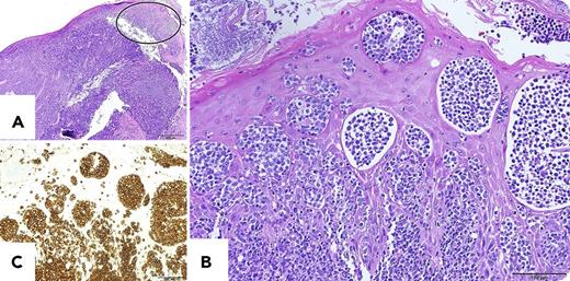A 69-year-old Japanese man was admitted to our hospital for examination of a sore throat during the past 3 months. Physical examination showed swelling of the right tonsil and right cervical lymph nodes. Hematoxylin and eosin imaging of the tonsil biopsy showed diffuse infiltration of medium-sized atypical lymphoid cells (panel A; bar: 500 μm). Interestingly, the atypical lymphoid cells infiltrated into the squamous epithelia covering the tonsil and formed aggregates (panel A, closed ellipse). Shown in higher magnification (panel B; bar: 100 μm), they reminded us of Pautrier microabscesses observed in primary cutaneous T-cell lymphoma such as mycosis fungoides (MF) or cutaneous infiltration of adult T-cell leukemia/lymphoma (ATLL). Immunohistochemically, these atypical lymphoid cells were positive for CD3 (panel C; bar: 100 μm), CD4, and FoxP3, and negative for CD20 and CD8. Together with monoclonal integration of human T-cell lymphotropic virus-1 provirus, a diagnosis of ATLL was made. / We have recently experienced another case of Pautrier-like microabscesses in the tonsil by non-ATLL peripheral T-cell lymphoma. Both cases had no cutaneous lesions. Tonsil infiltration of MF is reported to form Pautrier-like microabscesses. To our knowledge, this is the first report of Pautrier-like microabscesses in noncutaneous squamous epithelia by non-MF peripheral T-cell lymphoma.
