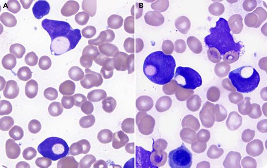 A 14-year-old, previously healthy adolescent girl presented with fatigue, shortness of breath, and headache for 1 month. Laboratory tests showed pancytopenia (hemoglobin, 4.7 g/dL; platelet count, 57 × 109/L; neutrophil count, 1.2 × 109/L) and 21% blasts. Bone marrow aspirate revealed 90% small- to medium-sized L1 lymphoblasts with frequent (22%) erythrophagocytosis (panels A-B: Wright’s stain, original magnification ×1000). Flow cytometry study was suggestive of pro‐B-cell acute lymphoblastic leukemia (B-ALL; CD19+TdT+CD10−) with aberrant partial expression of CD13 and CD33. Cytogenetic study showed a near-tetraploidy karyotype of 87<4n>, XX,-X,-X, add(1)(p36.1)x2,-7,-8, add(12)(p11.2), add(12)(p12), -14, -15, add(15)(q15), der(20) t(5;20) (q12;p11.2), +add(22)(p11.2), add(22)(q12). FISH analysis confirmed near-tetraploidy and ETV6/RUNX1 gene rearrangement. The diagnosis of precursor B-ALL was made. This patient was treated on a high-risk protocol because of age (>10 years) and achieved complete remission. She has been disease free for ≥5 years. / Erythrophagocytosis by leukemic blasts is a rare phenomenon of unknown pathogenesis and unclear clinical significance. It is mostly seen in acute myeloid leukemia, especially associated with monocytic differentiation, t(8;16)(p11;p13), t(16;21)(p11;q22), inv8(p11q13), or tetraploidy, and poor prognosis. It is extremely rare in ALL, with only a few reported cases, 1 of which was pediatric B-ALL with ETV6/RUNX1 gene rearrangement and good prognosis.