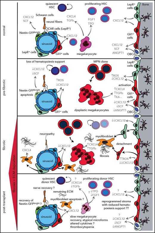 Figure 2. Stepwise reprogramming of the bone marrow niche with particular focus on stromal cell populations implicated as playing a role in MF. In the bone marrow (BM) niche under normal (healthy) conditions, HSC function is tightly controlled by a specialized microenvironment comprising sympathetic neurons, Nes+, LepR+, and Gli1+ MSCs and OBCs. These stromal cell subsets, megakaryocytes,77,83 growth factors, and cytokines control the proliferation and maintenance of the HSCs. In prefibrotic stages of PMF, hematopoietic stem and progenitor cells acquire genetic alterations in MPNs (MPN clone). The MPN clone gives rise to mutant dysplastic megakaryocytes that contribute to a proinflammatory environment that damages sensitive elements of the microenvironment such as Nes+ MSCs, Schwann cells, and their associated nerve terminals and thus contributes to the loss of normal hematopoiesis. Megakaryocytes derived from the malignant MPN clone significantly contribute to the reprogramming of stromal cells. Stromal cell subsets lose their hematopoiesis support (eg, loss of CXCL12 and increased cellular stress through accumulation of ROS and maintain a profibrotic environment that favors the malignant hematopoietic clone and leads to a vicious circle that results in bone marrow fibrosis and continuous production of extracellular matrix proteins, inflammation, loss of normal hematopoiesis, and expansion of the MPN clone. In the fibrotic phase, stromal cell subsets acquire an abnormal phenotype and start proliferating, detaching, and migrating from their normal niches; they can be found in abundance in the marrow cavity where they differentiate into myofibroblasts under the influence of CXCL4 secreted by megakaryocytes. They also start expressing CXCL4, which further negatively affects normal hematopoiesis and induces myofibroblast differentiation. The inflammatory environment created by the MPN clone, mutant megakaryocytes, and functionally and transcriptionally reprogrammed stromal cells (myofibroblasts) leads to a self-reinforcing niche. It remains unclear how this self-reinforcing niche is interrupted through HSCT. The posttransplant phase raises numerous open questions as indicated by the question marks. Detailed histopathologic studies on posttransplant bone marrow biopsies indicate resolution of bone marrow fibrosis but it remains an open question whether the reprogrammed stroma in bone marrow fibrosis regains its function and whether the stromal reprogramming is a reversible process after HSCT. Megakaryocytes in posttransplant bone marrows show atypical microforms exhibiting a dysplastic aspect that might be the result of an altered interaction between stromal cells (recipient bone marrow) and donor megakaryocytes that have not completely recovered their functionality. This disturbed interaction can in turn negatively affect regenerating hematopoiesis, in line with delayed hematopoiesis recovery in patients with bone marrow fibrosis after HSCT. Another open question is whether nerve fibers and nestin+ stromal cell subsets are able to recover after HSCT. Future studies will shed light on regenerative processes in the bone marrow microenvironment after HSCT and answer the question of whether the reprogrammed self-reinforcing niche in bone marrow fibrosis is reversible. Cytokines and growth factors are highlighted in gray. ANGPT1, angiopoietin; CAR, cxcl12-abundant reticular cells; CXCL12, C-X-C motif chemokine 12; CXCL4, C-X-C motif chemokine 4 (or platelet factor 4); ECM, extracellular matrix; FGF1, fibroblast growth factor 1; GFP, green fluorescent protein; IL6, interleukin 6 SCF, stem cell factor; TPO, thrompoietin.