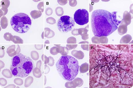 A 23-year-old Thai man presented with lethargy, arthralgia, diarrhea, fevers, and a papular rash. Past medical history was unremarkable. White cell count was 4.5 × 109/L (neutrophils 2.6 × 109/L, lymphocytes 0.1 × 109/L), hemoglobin 10 g/dL with mean corpuscular volume of 59 fL, and platelets 33 × 109/L. The peripheral blood film revealed small (2-5 μm) round-to-ovoid yeast cells with occasional central septa located predominantly within neutrophil cytoplasm (panels A-C; original magnification ×1000, May-Grünwald Giemsa stain). Also noted were striking neutrophilic dysplasia with large abnormal forms, binucleate cells (panel D; original magnification ×1000, May-Grünwald Giemsa stain), and frequent small nuclear fragments, some detached and others connected by a fine filament (panel E; original magnification ×1000, May-Grünwald Giemsa stain). Red cells were hypochromic and microcytic, with target cells consistent with known α-thalassemia trait. / The patient was subsequently diagnosed with AIDS, with an HIV viral load of 282 137 copies/mL and CD4 count of 8 cells/µL. Advanced HIV infection can cause marked dysplasia, with round nuclear fragments reported to be a specific feature. Blood cultures grew Talaromyces marneffei (formerly Penicillium marneffei), a dimorphic fungus that is an important opportunistic pathogen in southeast Asia (panel F; original magnification ×1000, Gram stain; courtesy of R. Chan, Infectious Diseases Department, Royal Prince Alfred Hospital, Sydney, Australia). With heavy fungemia the organisms may be seen on the peripheral blood smear, which can facilitate prompt diagnosis and treatment.