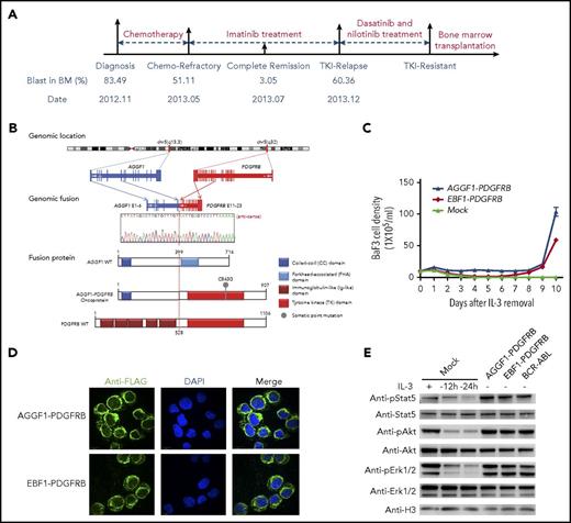 Figure 1. A novel fusion gene of AGGF1-PDGFRB in Ph-like ALL. (A) Schematic representation of the treatment course of the index patient with the AGGF1-PDGFRB fusion gene. Samples at diagnosis, at the end of induction (chemotherapy refractory), and at relapse were chosen for WGS and RNA-seq. (B) Schematic diagrams of AGGF1-PDGFRB based on the RNA-seq and WGS analyses. (C) Growth rate of Ba/F3 cells with AGGF1-PDGFRB, EBF1-PDGFRB, or empty lentivirus vector (mock) after removal of interleukin 3 (IL-3). (D) Localization of AGGF1-PDGFRB and EBF1-PDGFRB in Ba/F3 cells was detected by immunofluorescence (donkey anti-rabbit Alexa Fluor plus 555 and DAPI stain; original magnification ×200). (E) Lysate of Ba/F3 cells with AGGF1-PDGFRB, EBF1-PDGFRB, BCR-ABL1, and empty vector (mock) with or without IL-3 (10 ng/mL) to detect the phosphorylation of Stat5, Akt, and Erk1/2. All experiments were performed in triplicate. BM, bone marrow; DAPI, 4′,6-diamidino-2-phenylindole; pErk, phosphorylated Erk; WT, wild type.