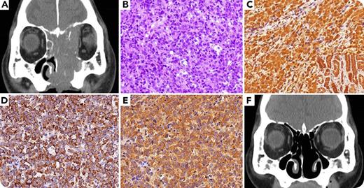 A 78-year-old man was admitted for diplopia. Computed tomography revealed a tumor mass in the left nasal cavity (panel A). Blood analysis showed the following: albumin, 46 g/L (normal, 38-53 g/L); calcium, 2.6 mmol/L (2.0-2.5 mmol/L); 25(OH)D3, 82.4 nmol/L (74.9-249.6 nmol/L); 1,25(OH)2D3, 196.0 pmol/L (52.0-156.0 pmol/L); parathyroid hormone (PTH), 19.4 ng/L (8.3-38.7 ng/L); and PTH-related protein, <1.0 pmol/L. The nasal tumor was biopsied and eventually diagnosed as diffuse large B-cell lymphoma (DLBCL), not otherwise specified (panel B; hematoxylin and eosin stain, original magnification ×400), of non–germinal center B-cell subtype, stage IV, with a high International Prognostic Index score. Furthermore, lymphoma cells were positive for 25-hydroxyvitamin D3-1α-hydroxylase (panel C, inset with normal kidney as the positive control; original magnification ×400), interleukin-6 (panel D; original magnification ×400), and tumor necrosis factor-α (panel E; original magnification ×400). Following rituximab, cyclophosphamide, doxorubicin, vincristine, and prednisolone therapy, the lymphoma lesions disappeared (panel F), and both serum calcium and 1,25(OH)2D3 levels decreased to 2.2 mmol/L and 142.2 pmol/L, respectively. / Vitamin D deficiency has been recently proven to impair outcomes of patients with DLBCL treated with rituximab-based therapy. In this case, the extrarenal 25-hydroxyvitamin D3-1α-hydroxylase production and proinflammatory cytokine production by lymphoma cells were considered to play a role in the pathogenesis of hypercalcemia.