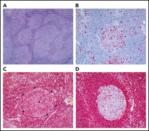 Figure 1. Histological appearance of FL. (A) Hematoxylin-and-eosin staining of an FL grade 1 (original magnification ×40). Note the numerous follicles of the FL that lost the typical dark-zone/light-zone demarcation and are surrounded by thin mantle zones. (B) Ki-67 staining of an FL, revealing the typical low fraction of proliferating cells in an FL follicle (original magnification ×100). (C) BCL2 staining of an FL, showing strong BCL2 staining of the lymphoma cells (original magnification ×100). The center of the FL follicle is marked with an asterisk (*); the thin mantle zone surrounding the follicle is marked with a pound symbol (#). (D) BCL2 staining of a reactive lymph node with BCL2+ mantle-zone B cells and BCL2− GC B cells (original magnification ×100). For the BCL2 staining, a mouse anti-human monoclonal antibody (clone 124; DAKO Agilent, Hamburg, Germany) was used; for the Ki-67 staining, a mouse anti-human monoclonal antibody (clone MIB-1; DAKO). Stainings were kindly provided by S. Hartmann and M.-L. Hansmann (Senckenberg Center for Pathology, University of Frankfurt/Main, Frankfurt, Germany).