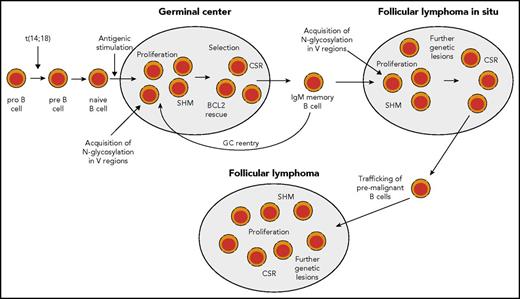 Figure 2. Scenario for FL pathogenesis. During early B-cell development, in rare instances, pro-B cells acquire a t(14;18) IGH-BCL2 translocation as a mistake of IGH recombination. This leads to constitutive expression of BCL2. t(14:18)-bearing B cells can develop further into mature naive B cells and may enter a GC reaction upon antigenic stimulation. In the GC, BCL2 is normally downregulated to promote apoptosis proneness of GC B cells. However, t(14;18)-carrying GC B cells have a survival advantage, and may clonally expand and become memory B cells. t(14;18)-positive B cells in the peripheral blood are mainly found among IgM memory B cells. Such cells may undergo repeated GC reactions and thereby acquire further genetic lesions. In some reactive lymph nodes, GCs dominated by monoclonal BCL2+ GC B cells can be found. These are called FLIS and the B-cell clones can be considered as premalignant as they often carry besides the t(14;18) further genetic lesions. From such structures, FLs can develop after additional gene mutations occurred. Furthermore, mutations promoting N-glycosylation of amino acids in the variable regions of the BCR have been detected in FLIS,28,61 so that chronic antigenic stimulation as an additional pathogenetic factor occurring through BCR stimulation by lectins on stromal cells can occur already in FLIS (and perhaps even earlier, as the mutations causing N-glycosylation may well occur in early GC passages, when SHM is highly active). Nearly half of FL cases express IgG, so that at some stage during FL pathogenesis, a considerable fraction of cases have undergone class-switch recombination (CSR).
