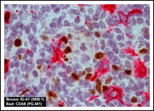 Figure 3. Macrophages are located close to proliferating FL cells. Macrophage marker CD68 (PG-M1) (red) and proliferation marker Ki-67 (MIB-1) (brown) show colocalization of macrophages and proliferating FL cells (original magnification ×1000).
