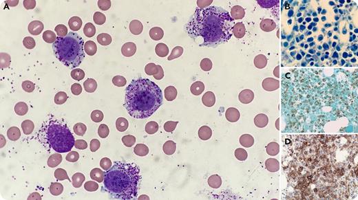 A 35-year-old woman who presented with recurrent episodes of flushing, headache, palpitations, and elevated serum tryptase (81.7 ng/mL) was treated with fexofenadine and imatinib and diagnosed with the aleukemic variant of mast cell leukemia (MCL), defined as a high percentage of mast cells in the bone marrow aspirate (BMA) but no mast cells in the peripheral blood. Cytogenetic studies were normal; however, molecular analysis revealed a KIT D816Y mutation (5.6%), and the patient was started on midostaurin. Evaluation 9 months later revealed disease progression, with BMA (73%) and peripheral blood involvement (18%) by atypical, hypogranular, round-to-oval mast cells (panel A; original magnification ×1000, Wright-Giemsa stain), with expansion of the KIT D816Y clone (13.7%). The bone marrow biopsy showed sheets of mast cells (panel B; original magnification ×1000, Giemsa stain) immunoreactive for mast cell tryptase (panel C; original magnification ×400) and CD25 (panel D; original magnification ×400). / MCL, a rare variant of systemic mastocytosis, typically presents with diffuse marrow involvement and organ damage. Although the majority of advanced mastocytosis cases carry the D816V KIT mutation, alternative mutations or variants, as in this case, have been reported. The aleukemic variant of MCL is more commonly seen, but transformation to overt MCL can occur. The atypical peripheral blood mast cells seen at follow-up were initially erroneously categorized as maturing myeloid cells, a pitfall that could lead to imprecise subclassification of MCL.