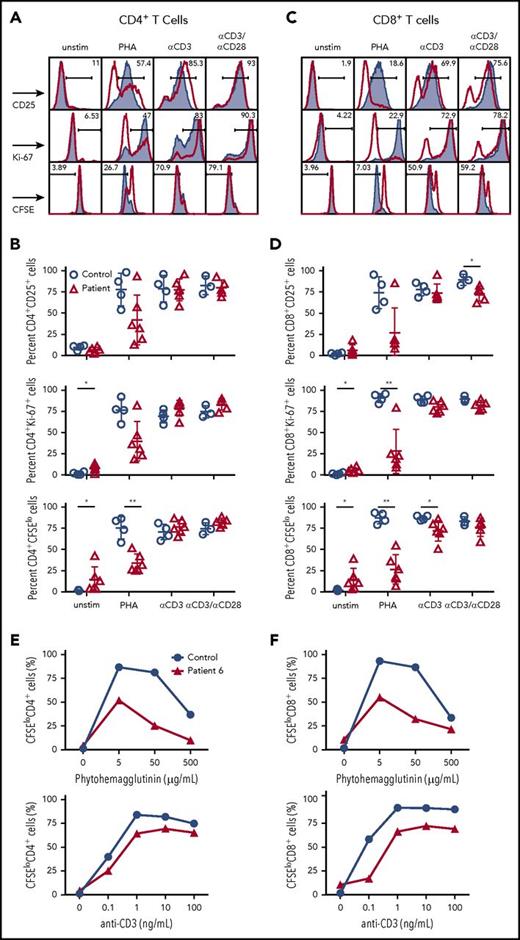 Figure 2. T-cell activation and cell division following mitogen stimulation. (A) Representative plots and (B) cumulative percentage of (top) CD25 expression, (middle) Ki67 expression, and (bottom) CFSE staining in CD4+ T cells from controls (solid gray) or CD3G patients (red) in unstimulated samples or following activation with PHA, anti-CD3, or anti-CD3/CD28. (C) Representative plots and (D) cumulative data for (top) CD25 expression, (middle) Ki67 expression, and (bottom) CFSE staining in CD8+ T cells from controls (solid gray) or patients (red) among the indicated groups. (A-D) Response to anti-CD3+anti-CD28 was studied in 5 patients (P1-P5) because not enough cells were available from P6. Dose titration curve of CFSE dilution among (E) CD4+ and (F) CD8+ T cells following stimulation with PHA (top) or anti-CD3 (bottom) for patient P6 (red line) and control sample (blue line). Unstim, unstimulated.