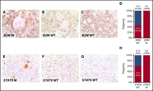 Figure 5. Expression of phosphorylated STAT6 and MHC-I proteins in cHL. Expression of MHC-I (A-C), and pSTAT6 (E-G) was examined by immunohistochemistry in formalin-fixed sections of cHL. (A) HRS cells with absent expression of MHC-I in a exemplificative B2M mutated cHL case. (B) HRS cells with absent expression of MHC-I in a exemplificative B2M wild-type (WT) cHL case, in which alternative genetic mechanisms not explored by our assay, may be responsible for the loss of MHC-I expression. (C) HRS cells with normal expression of MHC-I in a exemplificative B2M WT cHL case. Staining for MCH-I was absent on the HRS cell surface of 11/18 patients with cHL, as clearly shown by the lack of surface staining at the cell boundaries in the cluster of HRS cells, including 5/5 cases harboring B2M mutations and 6/13 cases lacking B2M mutations (D). (E) HRS cells with a nuclear overexpression of p-STAT6 in a cHL case harboring STAT6 mutation. (F) HRS cells with a nuclear overexpression of p-STAT6 in a exemplificative STAT6 WT cHL case, consistent with the plethora of genetic mechanisms affecting the cytokine signaling program in this tumor, some of which are not explored by our assay and may be responsible for the overexpression of p-STAT6. (G) HRS cells with absent nuclear expression of p-STAT6 in a exemplificative STAT6 WT cHL case. Staining for nuclear pSTAT6 was positive in HRS cells of 14/18 patients with cHL, including 8/8 cases harboring STAT6 mutations and 6/10 cases lacking STAT6 mutations (H). Original magnifications ×630.