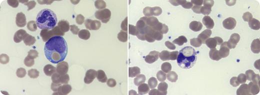 A 27-year-old woman was admitted to the hospital with cough and myalgia. She had no significant past medical history. Blood work showed hemoglobin 97 g/L (reference range, 120-160 g/L), bilirubin 113 µmol/L (reference range, <20 µmol/L), and lactate dehydrogenase 3420 IU/L (reference range, 120-250 IU/L). The patient had acute kidney injury, creatinine (Cr) 368 µmol/L (reference range, 45-90 μmol/L), and estimated glomerular filtration rate (eGFR) 14 mL/min per 1.73 m2 (reference range, >90 mL/min per 1.73 m2). Review of the blood film showed agglutination and erythrophagocytosis (Wright stain, original magnification ×100), suggestive of paroxysmal cold hemoglobinuria. Direct antiglobulin test was positive for C3d, and blood specimens appeared grossly hemolyzed. Nucleic acid amplification on a nasopharyngeal swab was positive for influenza A virus, respiratory syncytial virus, and adenovirus. The patient deteriorated rapidly. Twenty-four hours postadmission, hemoglobin fell to 54 g/L, requiring transfusion, and she developed oliguric renal failure (Cr 607 µmol/L, eGFR 8 mL/min per 1.73 m2), needing urgent hemodialysis. She was commenced on methylprednisolone, followed by oral prednisone with gradual resolution of hemolysis and anemia. Testing confirmed Donath-Landsteiner antibody when her plasma was not grossly hemolytic. Dialysis was ceased and renal function normalized over the ensuing weeks. / Paroxysmal cold hemoglobinuria with renal failure is rare, with only 3 adult cases reported in the literature. This case highlights the acute clinical deterioration that can occur and the blood film features, such as erythrophagocytosis, that may aid diagnosis.