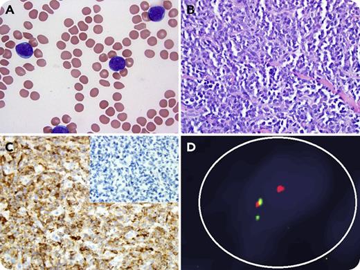 A 77-year-old man was diagnosed with B-cell acute lymphoblastic leukemia (ALL). Peripheral blood (panel A; original magnification ×100, Wright-Giemsa stain) showed medium-sized lymphoblasts with fine chromatin and multiple small nucleoli. By flow cytometry, the blasts expressed CD15, CD19, CD22, CD33 (dim, subset), CD38, CD45 (dim), PAX5, HLA-DR, and Tdt (dim). Cytogenetic analysis showed 46,XY,t(4;11)(q21;q23) consistent with a KMT2A(MLL)-AFF1(AF4) translocation. The patient was treated on the frontline blinatumomab study (NCT02143414) and achieved complete remission (CR) with negative minimal residual disease by multicolor flow cytometry. Eight months later, he presented with a subcutaneous mass on his chest, and biopsy showed sheets of medium-to-large atypical cells with fine chromatin and small nucleoli, consistent with myeloid sarcoma (panel B; original magnification ×20, hematoxylin and eosin stain). Immunohistochemical stains of tumor cells were positive for CD33, CD43, and lysozyme (panel C; original magnification ×20) but negative for CD19, PAX5 (panel C, inset), and Tdt. Fluorescence in situ hybridization for MLL (green signal, 5′ end; red signal, 3′ end) from the mass was positive for rearrangement (panel D). The bone marrow was negative for involvement by acute leukemia. The patient was treated with azacitidine and venetoclax and achieved CR. / Extramedullary escape and CD19 antigen loss are patterns of relapse following blinatumomab (CD3/CD19-bispecific T-cell engager) therapy in ALL. Interestingly, MLL+ ALL has the ability to undergo a myeloid lineage switch under the pressure of ALL-targeted therapies as a mechanism of resistance and adaptation.