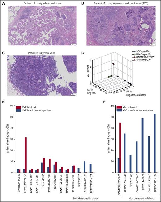 Figure 2. Validation of CHIP-associated mutations in hematopoietic elements. (A-B) A lung adenocarcinoma (A) and a lung squamous cell carcinoma (SCC) (B) were synchronously diagnosed in patient 11. Both specimens had extensive lymphocyte infiltration. CGP revealed distinct genomic alterations in each tumor except for identical genomic alterations in TET2 and DNMT3A. (C) A lymph node biopsy without histologic evidence of tumor was macrodissected to confirm the presence of CHIP mutations. (A-C) hematoxylin and eosin stain; scale bars represent 200 μm. (D) The same TET2 and DNMT3A genomic alterations were detected at a VAF of 1.5% and 1.7%, respectively, confirming their presence in hematopoietic elements; 3D scatter plot shows genomic alterations in all 3 samples with their respective VAFs. (E) Peripheral blood samples were available for 13 patients with TET2 and DNMT3A genomic alterations at VAFs lower than expected from purity. In 10 patients, targeted deep sequencing detected the identical genomic alterations in blood that were present in the associated solid tumor. There was no statistical difference between the VAFs of alteration in peripheral blood and solid tumor specimen (rank-sum P = .38). For the other 3 patients, we detected the genomic alterations in the macrodissected tumor cells enriched from the original samples, while the genomic alterations were absent or at significantly lower level in enriched macrodissected lymphocytes (supplemental Figures 7-9). (F) In the peripheral blood of only 1 of 7 sequenced patients with clonal TET2 and/or DNMT3A mutations, a genomic alteration previously found in the original solid tumor was detected (supplemental Figure 10).