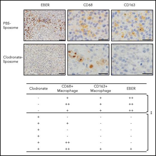 Figure 3. Depletion of CD163+macrophages induces the elimination of EBER+lymphoma cells in humanize mice model. Clodronate liposome (300 μL/mouse) was injected into Akata-infected mice (intraperitoneally). After 5 days, the spleens were collected. EBER was detected by in situ hybridization (upper). Scale bar, 50 μm. CD68/163 was detected by immunohistochemical staining. Scale bar, 20 μm. The effects of clodronate liposome in mice (lower). EBER and CD68/CD163 expression was analyzed in each mouse spleen. -, no EBER or CD68/163-positive cells in 1 microscopic field; +, <10 positive cells; ++, >10 positive cells. **P < .05, Student t test.