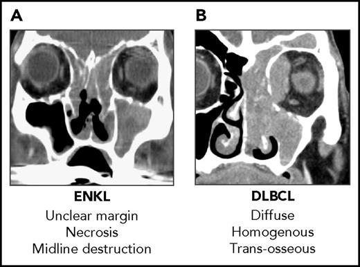 Figure 1. Radiological difference between ENKL and DLBCL. (A) Sagittal CT scan of a patient with ENKL. (B) Sagittal CT scan of a patient with DLBCL. It is difficult to diagnose the true extent of the tumor and contour the gross tumor volume in ENKL using only a CT scan. DLBCL, diffuse large B-cell lymphoma.