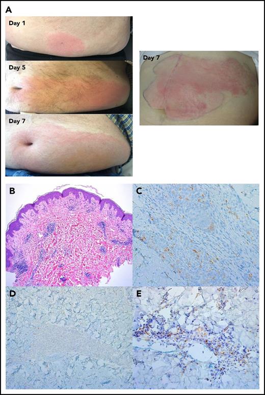 Figure 1. ALT-803 SQ injection-site reaction. (A) Shown is a representative injection site rash manifested as pink, edematous, nontender spreading plaque mimicking cellulitis. The sequence of rash expansion from days 1, 5, and 7 from different patients (left) and an additional example of the rash at day 7 (right). (B) Skin biopsy specimen showed a superficial and deep perivascular and perieccrine infiltrate consisting primarily of lymphocytes (hematoxylin and eosin, original magnification ×50). (C-E) Immunohistochemical analysis revealed that a predominance of cells were positive for CD56 (original magnification ×200) (C), negative for NKp46 (original magnification ×200) (D), and positive for TCRγ3.20 (original magnification ×200) (E), indicating presence of γδ T cells. Results are shown for 1 patient and are representative of 4 injection site reactions analyzed.