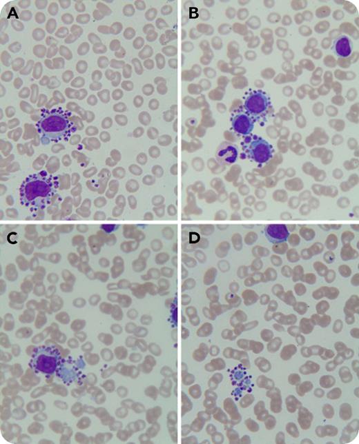 An 84-year-old woman presented to our institution with chest discomfort, dyspnea, and lower-extremity edema. She had undergone a percutaneous coronary intervention in 2013, and since then had been on clopidogrel bisulfate and aspirin therapy. Complete blood count showed: hemoglobin, 110 g/dL; white blood cell count, 13.49 × 109/L; and platelets, 137 × 109/L. A Wright-Giemsa–stained peripheral blood smear revealed 60% lymphocytes, with platelet satellitism almost exclusively around neoplastic lymphocytes (panels A-B; original magnification ×1000) and their cytoplasmic fragments (panels C-D; original magnification ×1000). Flow cytometry identified a monoclonal B-cell population of up to 27.8% that stained positive for surface markers CD19, CD20, CD22, FMC-7, CD23, CD25, CD103, CD200, and κ chain. The patient was diagnosed with B-cell lymphoproliferative disorder. Unfortunately, she had a hemorrhagic cerebral infarction and did not undergo further diagnostic workup and treatment. / Platelet satellitism around neutrophils is well recognized and is attributed to EDTA and its activation of platelets. Recently, it has been reported in lymphoid malignancies including mantle cell lymphoma and marginal zone B-cell lymphoma. Platelet satellitism around cytoplasmic fragments of neoplastic lymphocytes has not been reported. The present case may be due to aberrant surface molecules on neoplastic lymphocytes as a possible mechanism for platelet satellitism. Pseudothrombocytopenia may be present in patients with mild to moderate thrombocytopenia and lymphoid tumors.