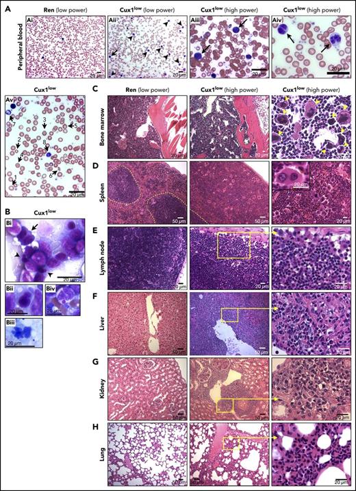 Figure 3. Myelomonocytic expansion and myelodysplasia in Cux1low mice. Representative morphology images are shown from mice at the time of euthanization because of disease. (A) Wright-Giemsa staining of the peripheral blood in (Ai) Ren and (Aii-Av) Cux1low mice. (Aii) The increased white blood cell count is primarily composed of mature granulocytes (arrowheads), monocytes (arrow), and (Aiii) occasional circulating myeloblasts (arrows). (Aiv) Dysplasia in the granulocyte lineage as evidenced by pseudo Pelger-Huet anomaly (arrows). (Av) Red blood cells in Cux1low mice have anisopoikilocytosis: (1) macrocyte; (2) microcyte; (3) target cell; (4) spherocyte; (5) tear drop cell; (6) and red cell fragment. (7) Polychromatophilic reticulocyte. (8) Giant platelet. (B) Touch preparation of Cux1low spleen shows erythroid dysplasia, including (Bi) binucleated erythroblast (arrow) and nuclear budding (arrowheads), (Bii) nuclear budding, and (Biii) abnormal nuclear contours. (Biv) Pseudo Chediak-Higashi granule in a maturing granulocyte. (C) H&E of Cux1low BM demonstrates numerous megakaryocytes. Nine megakaryocytes (yellow arrowheads) are shown in a single high-power field, several of which are atypically small, with hypolobation and condensed, hyperchromatic nuclei. (D) Compared with Ren, Cux1low spleen H&E staining demonstrates complete effacement of normal splenic architecture with expansion of red pulp and increased megakaryocytes. White pulp is outlined with a yellow dashed line for clarity. There is a small portion of residual white pulp in the bottom left corner of the Cux1low spleen (D, middle panel). Micromegakaryocytes are present, as well as megakaryocytes with hypolobation, abnormally widely spaced nuclear lobes, and hyperchromatic nuclei. H&E staining shows a myelomonocytic cell infiltrate in the following organs of Cux1low mice: (E) lymph nodes; (F) liver periportal and sinusoidal areas; (G) kidney; and (H) lung. Images were taken with a Zeiss Axioskop microscope.