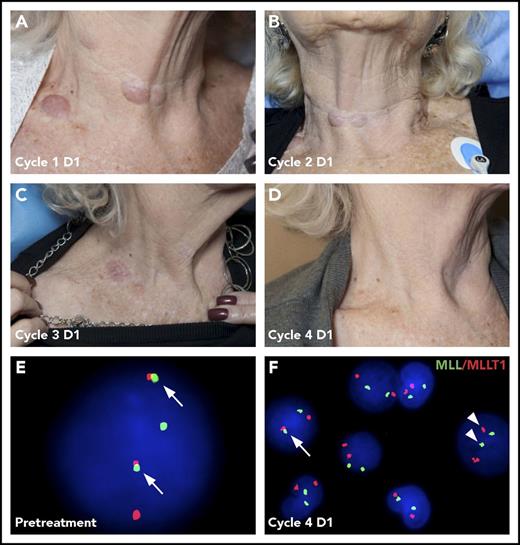 Figure 3. Resolution of leukemia cutis and cytogenetic changes following pinometostat treatment. Cutaneous leukemia cutis in an 81-year-old patient presenting with MLL-r CMML that was treated with 54 mg/m2 per day of pinometostat by 21-day CIV infusion. Leukemia cutis neck lesions that were apparent on day 1 (D1) at the start of treatment (A) progressively resolved over the course of subsequent treatment cycles (B-D). (E) Translocation-positive cell in a peripheral blood sample detected by FISH from the same patient showing the t(11:19) MLL-r product colocalizing with the MLLT1 fusion partner (arrows). (F) The number of translocation-positive cells (arrow) decreased from 90% pretreatment to 0.2% at the start of the fourth pinometostat treatment cycle, with most cells demonstrating normal segregation of MLL and MLLT1 signals (arrowheads).