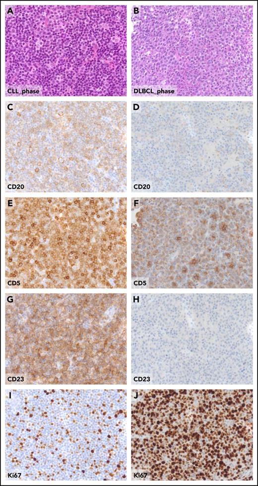 Figure 1. Pathologic aspects of the lymph node in the CLL phase and in the DLBCL phase from a patient who experienced clonally related RS transformation. Hematoxylin and eosin sections of CLL involved lymph node (A) and of DLBCL-type Richter transformation (B). The expression of CD20, CD5, CD23, and Ki67 detected by standard immunohistochemistry, the CLL-phase lymph node (C, E, G, I), and, for comparative purposes, in the DLBCL-type Richter transformation (D, F, H, J), are shown. Original magnification ×20 for all panels.