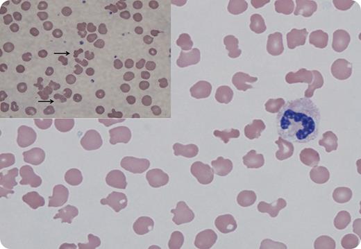A 52-year-old man with untreated hepatitis C presented to the hospital with cough and shortness of breath. The examination was notable for ≥3 pitting edema, and cross-sectional imaging showed pleural effusions and ascites. Laboratory findings revealed a hemoglobin of 7.6 g/dL, creatinine 2.2 mg/dL, total protein 6.2 g/dL, albumin <1.5 g/dL, and an immunoglobulin M monoclonal paraprotein of 1940 mg/dL. Hepatitis C quantitation by polymerase chain reaction was >11 million IU/mL; bone marrow biopsy identified B-cell lymphoma with plasmacytic differentiation (MYD88 mutation negative). The patient then developed a rash of dusky violaceous plaques and macules. Out of concern for cryoglobulinemia, rheumatoid factor was checked and found to be elevated at >6000 IU/mL with an elevated cryocrit of 7% consistent with the diagnosis. A peripheral smear at room temperature was notable for distorted red cells, morphologically mimicking schistocytes and acanthocytes (Wright stain; original magnification ×1000). Haptoglobin, lactate dehydrogenase, fibrinogen, and routine coagulation tests were normal. At a different light refraction, smear revealed a marked background of cryoprecipitate (inset, arrows; Wright stain; original magnification ×1000), depositing on and deforming the red blood cell (RBC) membrane. / This case illustrates bizarre RBC morphologic changes in the presence of cryoglobulinemia with smear findings that raise concern for intravascular hemolysis. The patient’s available historical data, including a normal complete blood cell count and spleen size, make hereditary RBC structural disorders a highly unlikely cause of these findings.