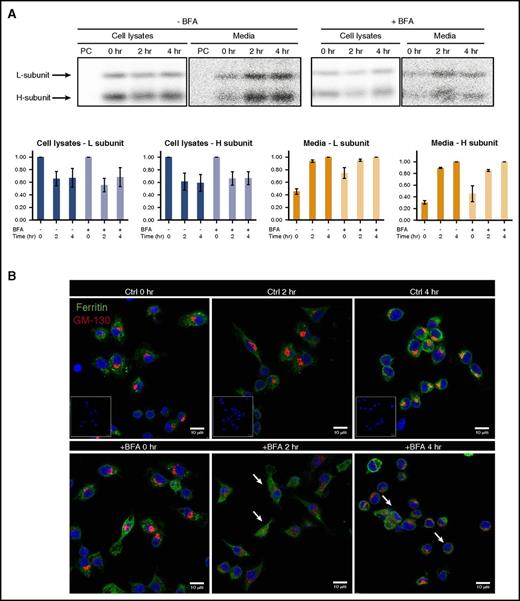 Figure 4. Ferritin is not secreted through the classical ER–Golgi secretion pathway. (A) Murine BMDMs were metabolically labeled with 35S in the presence of 100 μg/mL FAC and in presence or absence of 5 μg/mL BFA. Cells and media were collected at 0, 2, and 4 hours. Ferritin was immunoprecipitated from lysates and media with an anti-L-ferritin antibody and separated on SDS-PAGE. All samples were precleared (PC) by incubation with protein A sepharose beads alone to clear samples from nonspecific binding to the beads. L- and H-ferritin subunit band intensity was quantified using Adobe Photoshop software (each bar represents mean ± SD; n = 2). (B) Representative confocal images of ferritin (green) and the Golgi marker GM-130 (red) in murine macrophages (top, control, nontreated macrophages; bottom, BFA-treated macrophages). Negative controls were done with secondary antibodies only (insert, top panel) and with 1 primary antibody followed by both secondary antibodies to exclude channel leakage (not depicted). Scale bars represent 10 μm. Image visualization was performed on a LSM 700 (Zeiss) laser scanning inverted confocal microscope with a Plan-Apochromat ×63/1.4 numerical aperture oil differential interference contrast objective.