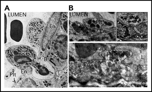 Figure 1. Platelet interactions with the vessel wall at sites of increased permeability and neutrophil transmigration. (A) A platelet bound to an emigrating neutrophil squeezing between 2 adjacent endothelial cells in an inflamed rat mesenteric venule. Adapted from Marchesi and Florey9 with permission. (B, upper left) A platelet can be seen adherent to the surface of the inflamed endothelium. Adapted from Marchesi8 with permission. (Upper right) A single platelet that seems to be sealing an open endothelial junction in an inflamed venule of the rat cremaster muscle. The white asterisks indicate the subendothelial accumulation of intravenously injected colloidal mercuric sulfide particles used as a marker of endothelial permeability. (Bottom) A single platelet filling an endothelial gap. Note that this platelet has lost its discoid shape, molding the interendothelial space. Adapted from Majno and Palade65 with permission. B, basement membrane; En, endothelial cell; G, endothelial gap; J, junction; L, lumen; Plt, platelet; R, red blood cell.