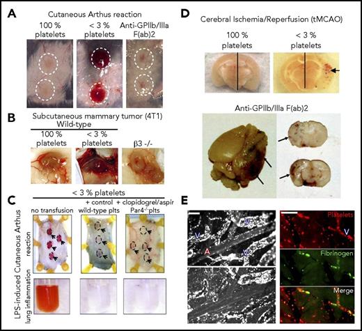 Figure 2. Prevention of inflammatory bleeding by platelets can occur independent of G protein–coupled receptors and GPIIbIIIa. (A) Representative images of cutaneous rpa spots showing that, unlike thrombocytopenic mice (<3% platelets), mice treated with a blocking F(ab')2 fragment antibody to GPIIb/IIIa did not develop bleeding in the inflamed skin. Adapted from Deppermann et al.33 (B) Representative images of mouse mammary tumor showing that, unlike thrombocytopenic mice (<3% platelets), mice with a genetic deficiency in β 3 integrins (β3−/−) did not develop tumor bleeding. Adapted from Ho-Tin-Noé et al49 with permission. (C) Transgenic hIL-4Rα/GPIbα mice were immunodepleted for platelets and transfused or not with control wild-type platelets or with platelets isolated from clopidogrel and aspirin-treated PAR4−/− mice. Those mice were then challenged in the skin with the rpA or in the lungs with LPS, as indicated. Representative images of the rpa site (dashed outlines and arrows) and of the bronchoalveolar lavage fluid are shown. Remarkably, just like control wild-type platelets, clopidogrel- and aspirin-treated PAR4−/− platelets protected against inflammatory bleeding in the inflamed skin and lungs. Adapted from Boulaftali et al32 with permission. (D) Representative images showing brain sections from mice that were subjected to tMCAO. The photographs were taken 24 hours after reperfusion. Hemorrhagic transformation under the form of petechial bleeding developed in the ischemic hemisphere of thrombocytopenic mice (<3% platelets) and of mice treated with a blocking F(ab')2 fragment antibody to GPIIb/IIIa. (Upper) Adapted from Goerge et al.32 (Lower) Adapted from Kleinschnitz et al.48 (E) Intravital imaging of cortical microvessels during MCAO. (Left) Rhodamine 6G labeling revealed that proximal occlusion caused a rapid and marked margination of leukocytes in venules downstream of the MCA (upper), which persisted and continued developing after recanalization (lower). Scale bar, 100 µm. (Right) tMCAO eventually led to secondary occlusion of postcapillary venules characterized by accumulation of platelets and fibrin(ogen). Scale bar, 50 µm. A, arteriole; V, venule. Adapted from Desilles et al49 with permission.