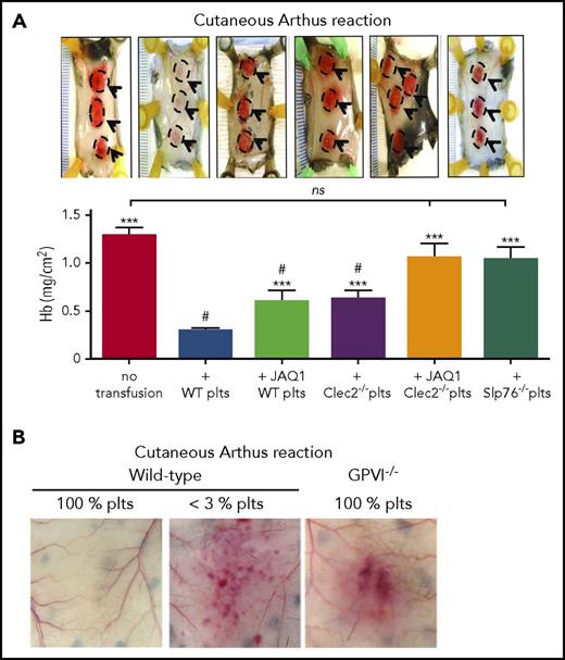 Figure 3. GPVI and CLEC-2 contribution to the prevention of inflammatory bleeding by platelets. (A) Transgenic hIL-4Rα/GPIbα mice were immunodepleted for platelets and transfused or not with control wild-type platelets, or with platelets with a deficiency in GPVI (JAQ1 WT platelets), CLEC-2 (Clec2−/− platelets), GPVI and CLEC-2 (JAQ1 Clec2−/− platelets), or in SLP76 (Slp76−/− platelets). Mice were then challenged with the cutaneous reverse passive Arthus reaction rpA and compared for inflammatory bleeding at the reaction site. Representative images of challenged skin (reaction spots are outlined) are shown above the bar graphs, which represent the mean hemoglobin content at the reaction site. Unlike control wild-type platelets, platelets with a deficiency in GPVI or CLEC-2 only partially prevented inflammatory bleeding. Notably, platelets with a combined deficiency in GPVI and CLEC-2, or platelets lacking Slp76, a signaling adapter protein downstream of GPVI and CLEC-2, did not prevent bleeding when transfused to thrombocytopenic hIL-4Rα/GPIbα–mice. Adapted from Boulaftali et al32 with permission. (B) Representative photographs showing that GPVI−/− mice with normal platelet count (GPVI−/− 100% platelets) are sensitized to rpa-induced skin bleeding. Adapted from Gros et al.34