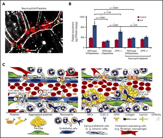 Figure 5. How platelets repair vascular injuries inflicted by infiltrating neutrophils. (A) Early platelet recruitment to the vessel wall during the cutaneous rpA, reaction as investigated by intravital microscopy. Platelets and neutrophils were stained in vivo, using fluorescent antibodies to GPIbβ (green color) and Ly-6G (red color). Single platelets were seen firmly adhering to the vessel wall and to neutrophils in areas of marked neutrophil margination and transmigration, which occurred in postcapillary venules. Scale bar, 100 µm. (B) Comparison of early platelet accumulation at the rpa site between control and thrombocytopenic wild-type mice and GPVI−/− mice, as assessed by measurement of skin PF4 content. In wild-type mice, the rpA led to the recruitment of platelets, which was reduced in GPVI−/− mice. Note that platelet recruitment to the inflamed skin was prevented by neutrophil depletion. Adapted from Gros et al.34 (C) Schematic representation of how platelets can prevent bleeding from sites of neutrophil extravasation in postcapillary venules. (Left) Single platelets are recruited to the inflamed vessel walls through interactions with activated endothelial cells and neutrophils, and with the exposed basement membrane. Recruited platelets play a dual role by promoting edema formation (yellow arrows, 1) and amplifying neutrophil infiltration through the secretion of permeability factors and chemokines (eg, serotonin, vascular endothelial growth factor receptor, PF4, RANTES, SDF-1), while ensuring inflammatory hemostasis. Concomitantly with or subsequently to their pro-inflammatory effects, single platelets indeed prevent bleeding by filling gaps between endothelial cells and plugging breaches in the basement membrane caused by extravasating neutrophils (2). This protective action of platelets would notably involve interactions between GPVI and components of the exposed subendothelium (eg, laminin or collagen), and/or between CLEC-2 with podoplanin-expressing stromal cells in close proximity to blood vessels (eg, macrophages, fibroblasts). In addition to a mechanical action, platelets engaged by these pathways might also trigger vascoconstriction, bridge endothelial gaps (3), or promote closing of endothelial junctions (4) over holes in the basement membrane, through the secretion of antipermeability and endothelial cell survival factors (eg, S1P, angiopoietin-1, ADP, ATP). (Right) In case of more severe endothelial injury, as in models of cerebral ischemia-reperfusion, inflammatory hemostasis would rely on more classical mechanisms including GPIIb/IIIa-mediated platelet aggregation (5).