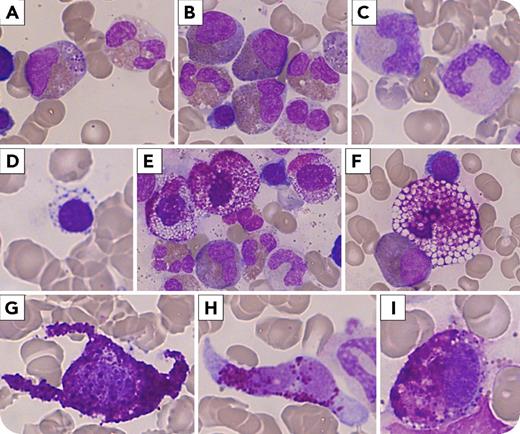 A 50-year-old man presented with flushes, fever, intestinal disorders, urticaria pigmentosa, and splenomegaly. Anemia and thrombocytopenia associated with hypereosinophilia (16.5 g/L) were found. Cytomorphological examination of a bone marrow aspiration revealed dystrophic eosinophilic precursors, erythroid and granular myeloid-associated dysplasia (panels A-D; in all panels, May-Grünwald-Giemsa stain; original magnification ×1000) related to a myelodysplastic syndrome with multilineage dysplasia (MDS-MD). It associated with a high infiltration (8%) of abnormal mast cells (MCs). Most MCs were degranulated, displaying a very atypical foamy aspect with large optically empty vacuoles, and were often grouped within islet-like cell clusters (panels E-F). Flow cytometry analysis showed aberrant expression of CD2 and CD25 on KIT+/FceRI+ MCs. The serum tryptase level was at 773 ng/mL. Trephine biopsy confirmed the diagnosis of aggressive systemic mastocytosis (ASM) with associated hematological neoplasm (AHN). Molecular biology found neither D816V KIT mutation nor any mutation on panexonic sequencing of the KIT gene. Screening for BCR-ABL1 and FIP1L1-PDGFRA was negative. The disease evolved 9 months later into MC leukemia refractory to many lines of treatment, and the patient died 2 years after the diagnosis. / This is a very unique case of an ASM-AHN (MDS-MD) with foamy MCs, contrasting with classical cytomorphology of spindle-shaped (panels G-H) or hypogranulated MCs (panel I) also present to a lesser extent.