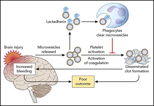 Mode of action of lactadherin in alleviating the consequences of TBI. TBI results in the release of brain-derived microvesicles, which activate coagulation and result in a consumption coagulopathy. Both systemic thrombosis and secondary brain hemorrhage as a result of exhaustion of platelets and coagulation factors result in poor outcome. Lactadherin binds to brain-derived microvesicles, which are subsequently cleared by phagocytes. Professional illustration by Patrick Lane, ScEYEnce Studios.