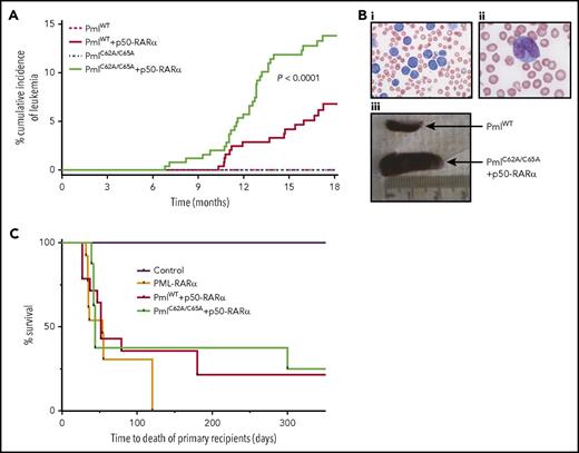 Figure 2. Pml NB disruption improves induction of APL. (A) Kaplan-Meier curve showing cumulative incidence of APL in PmlWT (n = 249), PmlC62A/C65A (n = 251), PmlWT+p50-RARα (n = 252), and PmlC62A/C65A+p50-RARα (n = 251). (Bi-ii) Representative pictures of blood smear of moribund PmlC62A/C65A+p50-RARα mice showing hyperleukocytosis (May-Grünwald Giemsa staining; original magnification ×20 (i) and ×100 (ii)). (Biii) Representative spleens of PmlWT healthy control and PmlC62A/C65A+p50-RARα leukemic mice. (C) Kaplan-Meier survival curve of mouse primary recipients transplanted with PmlWT+p50-RARα (n = 14) and PmlC62A/C65A+p50-RARα (n = 8) leukemic BM cells, from 3 independent leukemias each. Mouse recipients transplanted with PML-RARα leukemic BM cells (n = 13) from 3 independent leukemic samples. This graph represents pooled data from 2 independent experiments. (A,C) Log-rank tests were used to compare survival curves.