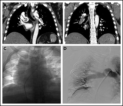 Figure 1. Submassive pulmonary embolism in patient 2. (A) Coronal CT demonstrating thrombus (arrows) in the right main and left lower-lobe pulmonary arteries. (B) Bulky thrombus is identified in the right lower-lobe pulmonary artery (arrow). (C) Wires and catheters traversing the thrombus in the right main and lower-lobe pulmonary artery. (D) Completion pulmonary angiography demonstrating good pulmonary perfusion.