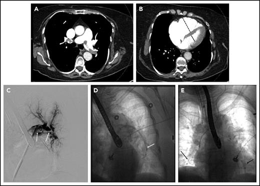 Figure 2. Massive pulmonary embolism in patient 3. (A) Axial CT image demonstrating thrombus in the right and left main pulmonary arteries. (B) Axial CT image through the heart demonstrating an enlarged RV (dashed line) to LV (solid line) ratio. (C) Thrombus on pulmonary angiography (arrows), extending from the left main pulmonary artery into the left lower-lobe pulmonary artery. (D) Indigo aspiration device (arrow) within the left lower-lobe pulmonary artery. (E) Placement of bilateral CDT infusion catheters (arrows).