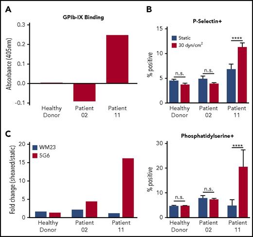 Figure 4. Sera from patients with chronic ITP with anti-GPIb-IX antibodies induce MSD unfolding and shear-dependent platelet signaling. (A) Enzyme-linked immunosorbent assay absorbance values for representative patient samples binding to GPIb-IX. Bars represent the values for plasma binding to purified GPIb-IX plus bovine serum albumin minus the values for bovine serum albumin binding alone. (B) Graphs of percentage of positive events for P-selectin (top) and phosphatidylserine (bottom) exposure in healthy donor platelets reconstituted in plasma from healthy donors, patient 02, or patient 11 under sheared (30 dyn/cm2) or static conditions (n = 4-5). (C) Graphs of fold increase (sheared/static) in 5G6 and WM23 binding to healthy donor platelets reconstituted in plasma from healthy donors, patient 02, or patient 11. Bars represent the mean of duplicate (n = 2) values for each condition. Variance in WM23 fold change was 12% to 15% of total. Variance in 5G6 fold change was 5% to 17% of total. ****P ≤ .0001.