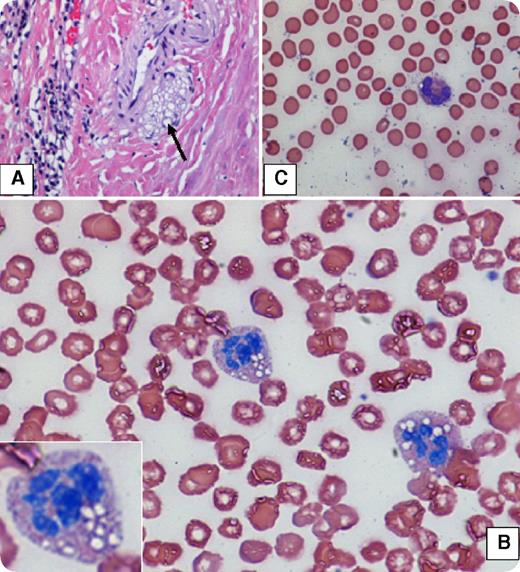 A 17-year-old woman was evaluated for bleeding in the postoperative period after tonsillectomy. Her past medical history is notable for myopathy and liver dysfunction. She was referred to our hematology office after extensive testing found no etiology for her bleeding. Hematoxylin and eosin (H&E) staining of resected tonsil demonstrated lipid-rich deposits (panel A; original magnification ×100). A peripheral blood smear revealed prominent lipid-laden vacuolated granulocytes (panel B; Wright stain, original magnification ×100), a finding known as Jordans anomaly, which is pathognomonic for neutral-lipid storage disease (NLSD). Sequencing of the PNPLA2 gene uncovered a 2-exon deletion confirming the diagnosis. The patient was put on a medium-chain lipid–rich diet with improvement in her symptoms and no further bleeding. Interestingly, a peripheral blood smear from the patient’s mother (panel C; Wright stain, original magnification ×100) showed only occasional vacuolated granulocytes, consistent with a heterozygous genotype. / The NLSDs are a collection of congenital autosomal recessive disorders manifested clinically by 2 separate syndromes: myopathy with ichthyosis (Chanarin-Dorfman syndrome), caused by mutations in the ABHD5 gene, and myopathy without ichthyosis, caused by mutated PNPLA2. NLSDs are extremely rare, with fewer than 100 documented cases. Lipid accumulation is most prominent in myocytes, hepatocytes, and granulocytes, although other tissues are often involved. Bleeding has not been described and, in this case, likely reflects lipid accumulation at the surgical bed.