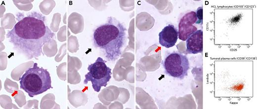 A 43-year-old woman presented with chronic renal failure evolving for 1 year. There were no B symptoms suggestive of a tumor. The kidney biopsy showed a κ light chain deposition disease. Free κ light chains were elevated (836 mg/L) with a κ/λ ratio of 39. A bone marrow aspirate smear had 28% of plasma cells (panels A-C, red arrows, original magnification ×1000; May-Grünwald Giemsa staining) leading to the diagnosis of multiple myeloma (MM). Unexpectedly, it showed 2% of hairy cells (panels A-C, black arrows) with bean-shaped nuclei, ground-glass chromatin, and abundant pale blue cytoplasm with circumferential hairy projections. Bone marrow immunophenotyping confirmed both λ monotypic hairy cell leukemia (HCL) (CD19+/CD103+/CD11c+/CD25+/CD123+) (panel D) and abnormal κ monotypic plasma cells (CD38+/CD138+/CD19−/CD45+/−) (panel E). After treatment with bortezomib, cyclophosphamide, and dexamethasone, the patient achieved very good partial response for MM, and peripheral blood immunophenotyping did not identify any HCL lymphocytes. / Given that the BRAF V600E mutation is characteristic of HCL, but has also been described in ∼5% of MM, the association of both diseases raised the hypothesis of a shared clonal origin. However, after cell sorting, the BRAF V600E mutation was found in the CD19+ fraction (HCL), but not in the CD138+ fraction, confirming that both diseases were unrelated.