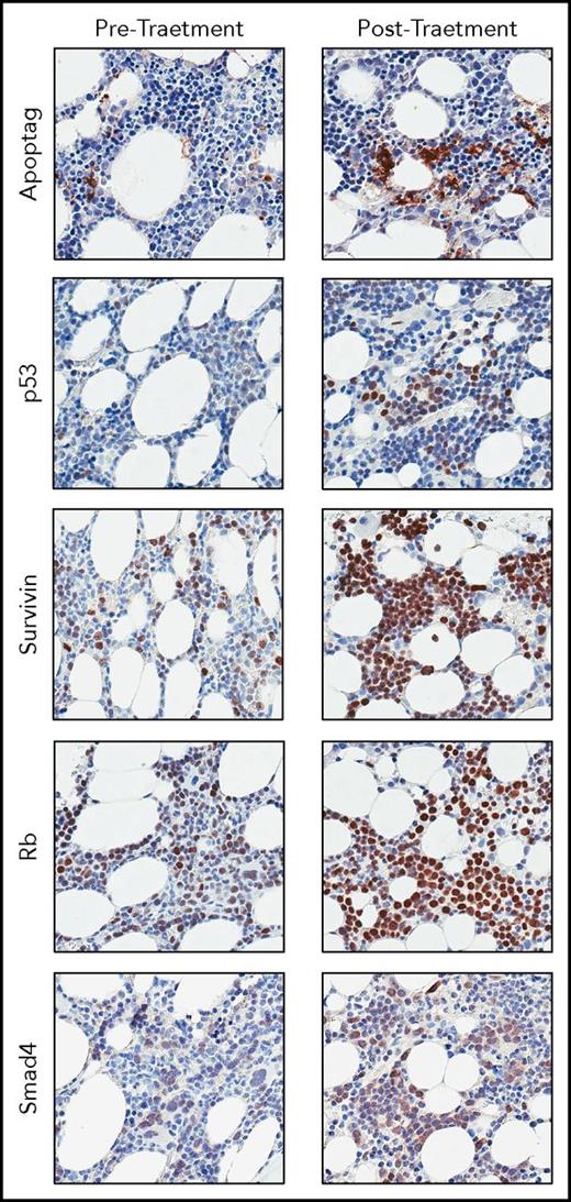 Figure 1. Representative staining of bone marrow aspirates collected from a patient at baseline and after 1 cycle of treatment with 45 mg/m2 selinexor + 20 mg dexamethasone, twice weekly. The patient achieved a best response of PR while on study. Staining shows increased apoptosis (Apoptag) and nuclear accumulation of known TSP cargoes of XPO1 (p53, survivin, Rb, and Smad4).