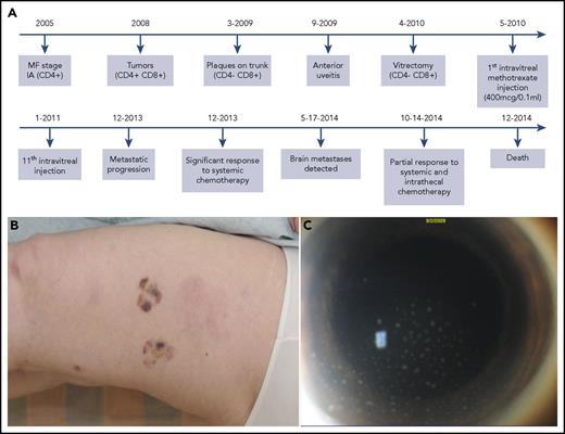 Figure 1. Patient 1 timeline, clinical progression, and intraocular disease burden. (A) Timeline of case 1, including the immunophenotype of the various tumor sites and the intraocular involvement. This timeline highlights the evolution of the immunophenotypic switch, the diagnosis of intraocular involvement, and the subsequent treatments. (B) The new cutaneous tumors, which erupted in 2008, were the first evidence of immunophenotypic switch from CD4+ to mixed CD4+/CD8+. (C) Anterior segment photograph demonstrating anterior chamber cellular reaction with keratic precipitates composed of tumor cells on the endothelial surface of the cornea. These intraocular cells were CD4−/CD8+.