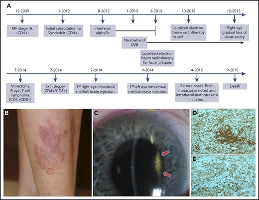 Figure 2. Patient 2 timeline, clinical progression, vitreous tumor, and immunohistochemical stains demonstrating shift. (A) Timeline of case 2, including the evolution of the immunophenotypic switch, the diagnosis of intraocular involvement, and the treatment course. (B) An ill-defined red plaque with multiple follicular-based red papules present during initial consultation. (C) Slit lamp photograph of the right eye showing dense vitreous tumor cellular involvement behind the lens. The vitritis filled the entire vitreous cavity, but is only visible in this photograph in the area illuminated by the slit beam (arrows). (D-E) Immunohistochemical stains of cutaneous biopsy taken at time of intraocular diagnosis. Note the strong positivity for both CD4 (D) and CD8 (E) indicating a mixed immunophenotype of the cutaneous tissue, even at the same time that the intraocular tumor was CD4−/CD8+. Original magnification ×10 for panels D-E. R, right.