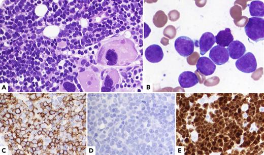 An 83-year-old man was diagnosed with JAK2 V617F–positive polycythemia vera (PV) 7 years ago. He was treated with intermittent phlebotomy. Six years later, he developed post-PV myelofibrosis and was treated with ruxolitinib. Current bone marrow biopsy showed B-cell acute lymphoblastic leukemia (B-ALL). Blasts had round nuclei with dispersed chromatin and small amounts of agranular cytoplasm (panel A, hematoxylin and eosin stain, original magnification ×400; panel B, Wright-Giemsa stain, original magnification ×1000). Immunophenotypically, blasts were positive for CD20 (panel C), CD22, CD79a, and terminal deoxynucleotidyl transferase (panel E) and negative for CD10, CD19 (panel D), CD34, and PAX5 as well as T and myeloid markers. Molecular study showed JAK2 V617F mutation with a low variant allele frequency (VAF) of 2%. In addition to B-ALL, there were loose clusters of hyperplastic megakaryocytes (panel A) in the background, consistent with residual myeloproliferative neoplasm. / BCR-ABL1–negative myeloproliferative neoplasms can undergo blastic transformation, and blasts are almost always myeloid. Blasts in this case, however, were of the B-cell lineage. Another unusual feature of this case is the immunophenotype of B-cell lymphoblasts with negative CD19 and PAX5. The discrepancy between the high percentage of blasts involving bone marrow and the low VAF of the JAK2 V617F mutation indicates that leukemic blasts were JAK2 V617F negative. These 2 clones were likely independent, but the possibility that B-ALL and PV shared and derived from a common JAK2 V617F–negative ancestor cannot be excluded.