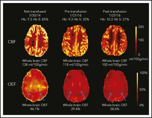 Figure 2. CBF and OEF maps from a child with SCA. This 7-year-old boy underwent an MRI scan before CTT initiation and again before and after an exchange transfusion (only CTT values included in cohort-level analyses). The whole-brain CBF was highest at his first scan (138 mL/100 g per minute). After 17 months of CTT, his pretransfusion CBF was lower than his initial scan (118 mL/100 g per minute; 14% drop) and further decreased after transfusion to 100 mL/100 g per minute (15% drop). The whole-brain OEF was highest at the first scan (46.1%), with dramatic reduction in OEF measured pretransfusion (29.4%; 38% drop) and only modest reduction posttransfusion (28.6%; 3% drop). His OEF maps were also notable for regionally elevated OEF in the deep white matter (blue arrows), which was most prominent before CTT initiation. This peak OEF was still detectable on the pretransfusion scan, although less prominent. After transfusion, the peak OEF region was absent, with restoration of homogeneous OEF across the brain.