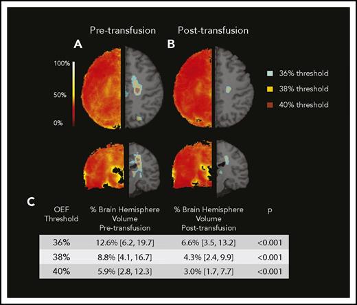 Figure 4. Regional peak OEF diminishes with transfusion. Averaged pretransfusion (A) and posttransfusion (B) OEF maps. Left side demonstrates averaged map. Right side demonstrates regions above successive thresholds as applied to averaged maps. (C) Median percentage of hemispheric brain volume above OEF thresholds decreased after transfusion.