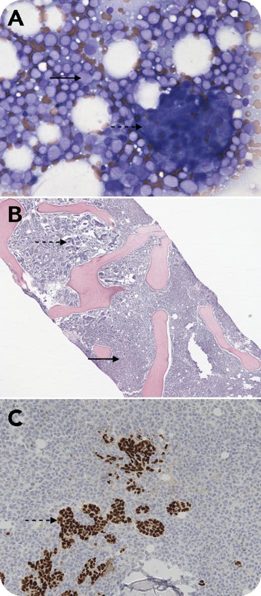 A 53-year-old woman was admitted with right thigh pain. She was diagnosed with estrogen receptor (ER)- and progesterone receptor (PR)-positive stage III adenocarcinoma of the left breast 3 years before. She was treated with lumpectomy and adjuvant doxorubicin and cyclophosphamide followed by paclitaxel and radiotherapy, but declined hormonal therapy. A right hip radiograph showed multiple lytic lesions, and positron emission tomography/computed tomography imaging confirmed widespread bony lesions. A complete blood count revealed a white blood cell count of 25 × 109/L with 20% blasts, a hemoglobin count of 11.1 g/dL, and a platelet count of 52 × 109/L. Bone marrow touch preparation (panel A; Wright's stain, original magnification ×400) and core biopsy (panel B; hematoxylin and eosin stain, original magnification ×40) were effaced by myeloblasts (solid arrows) and infiltrating adenocarcinoma arranged in clusters, ducts, and cords (dashed arrows) that were ER (panel C, dashed arrow; original magnification ×200) and PR positive and Her2 negative by immunohistochemistry. Cytogenetics revealed t(9;11)(p22;q23) and monosomy 7. Fluorescent in situ hybridization was positive for an MLL rearrangement. The patient was started on an aromatase inhibitor for her metastatic breast cancer and hypomethylating therapy for her acute myeloid leukemia (AML). / Rearrangements of the MLL (or KMT2A) gene are frequently seen in therapy-related AML after treatment with topoisomerase II inhibitors with a short latency of 2 to 3 years as compared with AML induced by alkylating agents, which has a latency of 5 to 7 years.