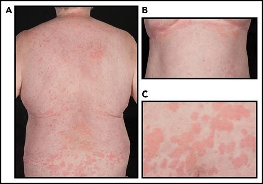 Figure 1. Characteristic urticarial rash in a patient diagnosed with Schnitzler syndrome. (A) Posterior and (B) anterior trunk, and (C) closeup view of the skin lesions.