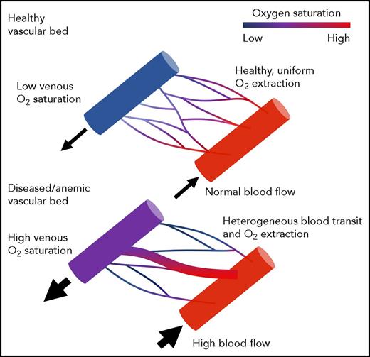 Schematic illustrating normal oxygen delivery to tissues through a healthy microvasculature (top). Slow, evenly distributed blood flow facilitates effective oxygen transfer. In this scenario, tissue OEF mirrors the oxygen difference between the artery and vein. Schematic illustrating impaired oxygen delivery in regions with vascular pruning and inhomogenous vascular transit time (bottom). Fast flow through low-resistance channels leads to high nonnutritive perfusion and ineffective oxygen unloading. The tissues are hypoxic (high OEF), even though the oxygen difference between the artery and the vein is small. Figure provided by Adam Bush.