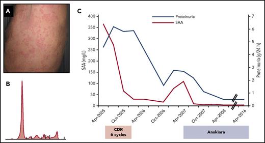 Clinical presentation and course of a patient with Schnitzler syndrome and reactive AA amyloidosis treated with anticlone therapy followed by IL-1 blocking treatment. A 55-year-old man was diagnosed with amyloidosis by renal biopsy. (A) During the previous 30 years, he had chronic nonpruritic urticarial rash associated with recurrent fever (up to 39°C) and arthralgia. Proteinuria and subsequent nephrotic syndrome were associated with profound postural hypotension and diarrhea. (B) A small (8 g/L) IgMκ monoclonal protein was detected with a 6% clonal bone marrow lymphoplasmacytic infiltrate. Proteinuria was 4.6 g per 24 hours, and there were no signs of amyloid cardiac or liver involvement. Amyloid deposits were detected in the abdominal fat, which reacted with anti-serum amyloid A (anti-SAA) apolipoprotein antibodies and not with anti-κ and anti-λ light chain antibodies. (C) A diagnosis of AA amyloidosis due to Schnitzler syndrome with kidney and autonomic nervous system involvement was made, and the patient was treated with cyclophosphamide, rituximab, and dexamethasone, with improvement of clinical symptoms and reduction of SAA and proteinuria. After 18 months, an increase in SAA and proteinuria accompanied an exacerbation of symptoms, and the patient was placed on anakinra, resulting in complete clinical remission and normalization of SAA and proteinuria. Apr, April; CDR, cyclophosphamide, rituximab, and dexamethasone; Oct, October; SAA, serum amyloid A.